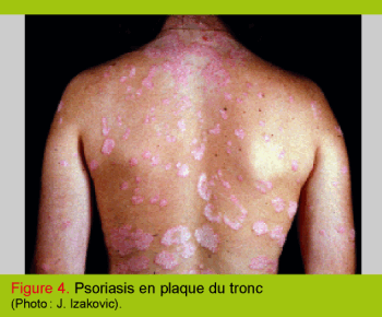 A guéri le psoriasis de lenfant
